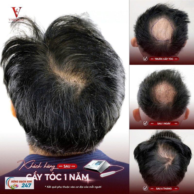 Mơ thấy rụng tóc - Tóc gắn chặt với hình ảnh bản thân